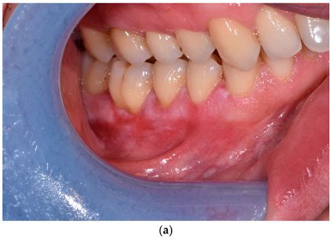 Liquen Plano Oral Reticular When To See A Dermatologist For Lichen