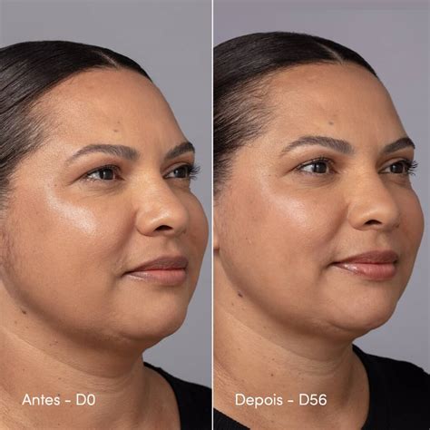 Bioestimulador De Colágeno Glúteo Antes E Depois - Como funciona o bioestimulador de colágeno na pele | Eudora
