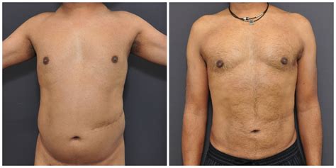 liposuction  men san francisco david sieber md