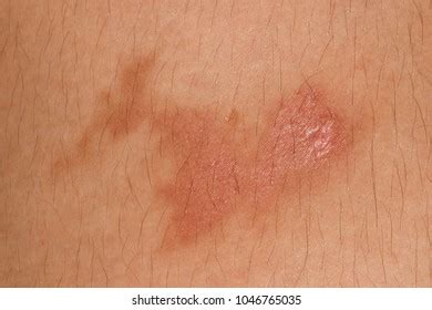 Skin Peeling After Sunburn Cool Weather Stock Photo 1046765035 ...