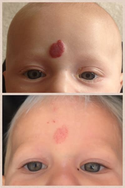 Strawberry Birthmark | Mumsnet