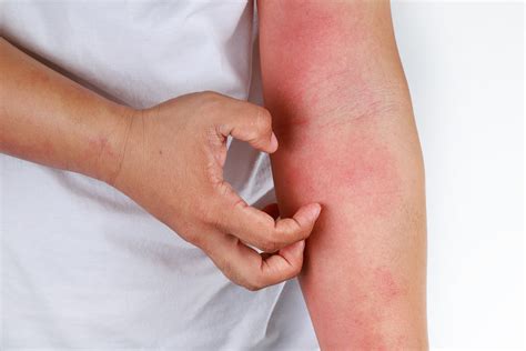 Skin Rashes - SJH Derm