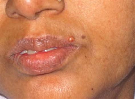 Hiv Rash On Lips | Lipstutorial.org