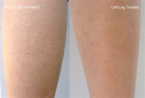 Laser Hair Removal Treatment in Marina Del Rey, CA | True Jewel