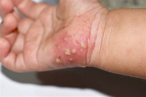 skabies patofisiologi diagnosis penatalaksanaan alomedika