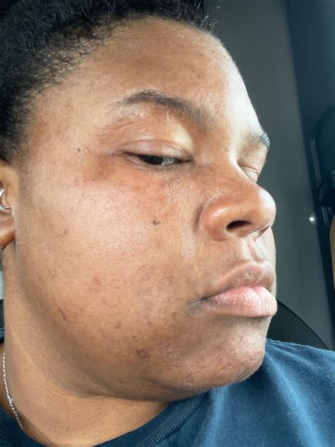 face toner with apple cider vinegar 9