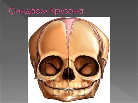 Синдром Крузона (фото): основные причины возникновения, признаки и ...