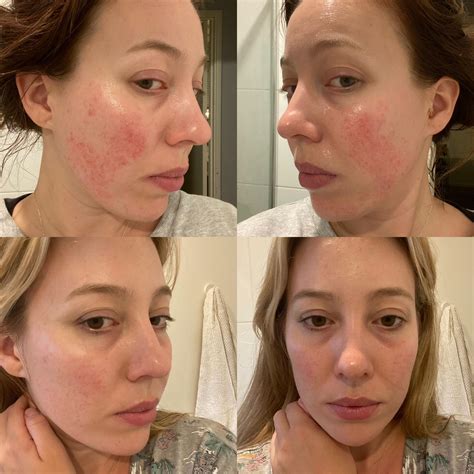 6 months difference : r/Rosacea