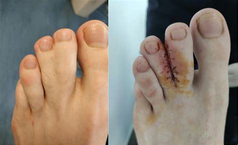 syndactyly webbed toes foot podiatry surgery