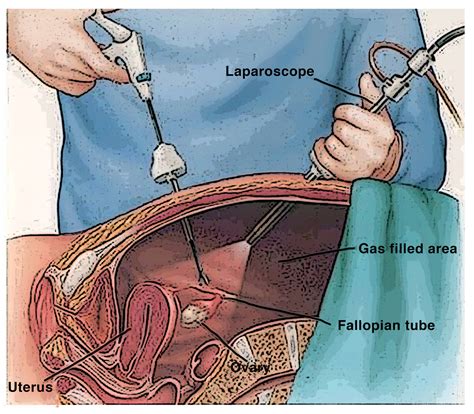 Laparoscopic Surgery for Endometriosis - Statesboro Women's Health ...