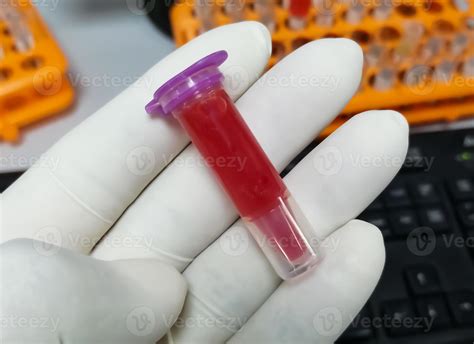 científico sosteniendo eppendorf con muestra de sangre hemolizada. la