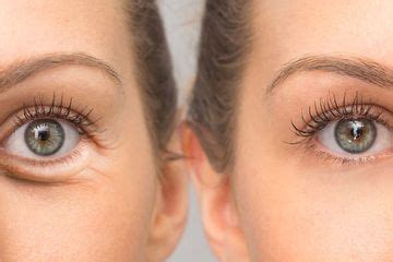 berita perbedaan garis halus  kerutan terbaru hari  cewekbanget