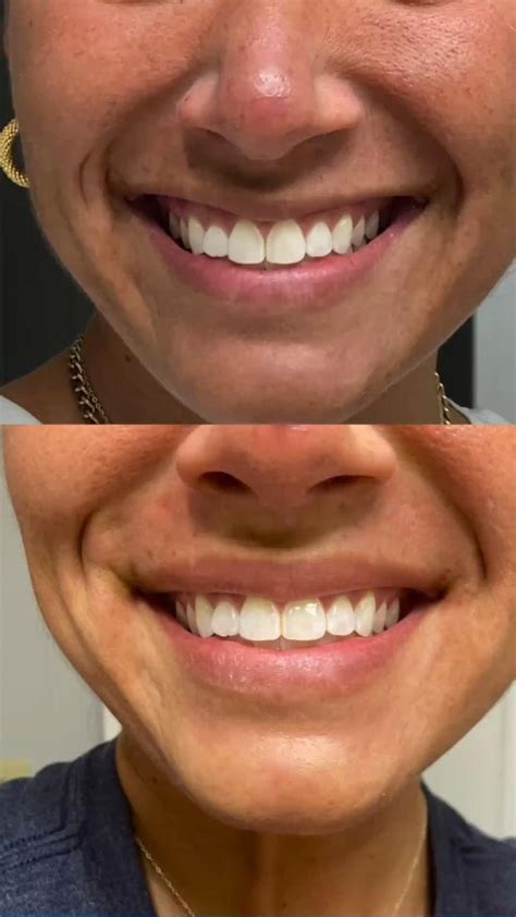 lip flip    lips botox lips medical needle syringe sets