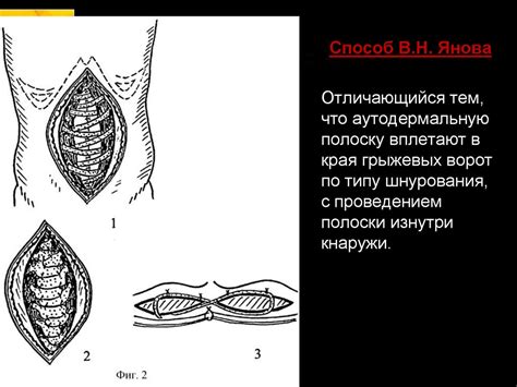 Послеоперационные вентральные грыжи - презентация онлайн