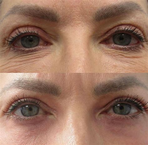 fractional  laser skin resurfacing  holistic health centre