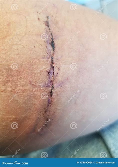 Surgery editorial stock photo. Image of distal, tear - 136690658