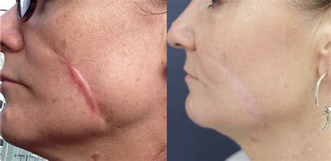 Scar Treatment in London - Dr Firas Al-Niaimi | London Dermatologist