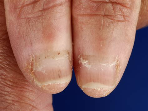 Splinter Hemorrhage Under Thumb Nail at Dylan Belstead blog
