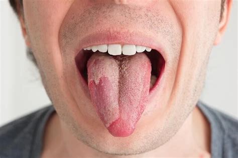 O Que Causa Sapinho Na Boca De Adulto - Sapinho na Boca (Candidíase Oral) - O que causa? Qual remédio?