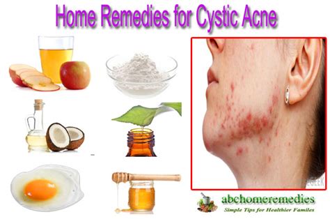 Home Remedies For Cystic Acne