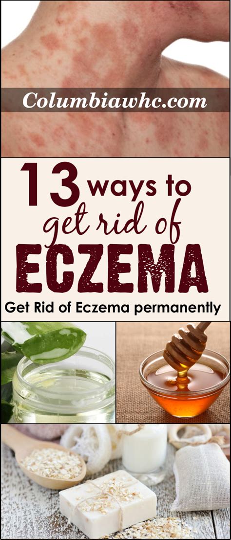 13 Amazing Ways To Get Rid Of Eczema Very fast At Home | Get rid of ...