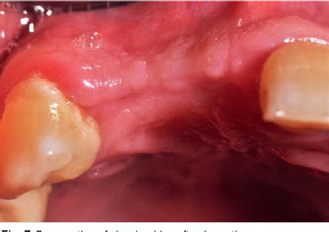 Figure 7 from Preservation of alveolar ridge in the maxillary esthetic ...