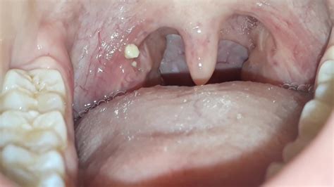 Tonsil Stones Removal - YouTube