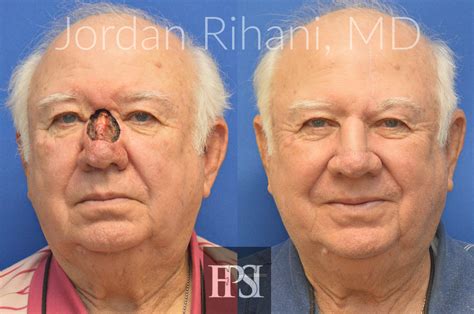 Facial Reconstruction - Facial Plastic Surgery Institute