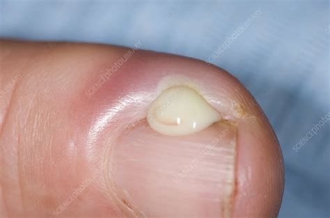 finger infection paronychia