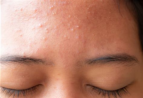 Common skin bumps and their treatment | The Financial Express