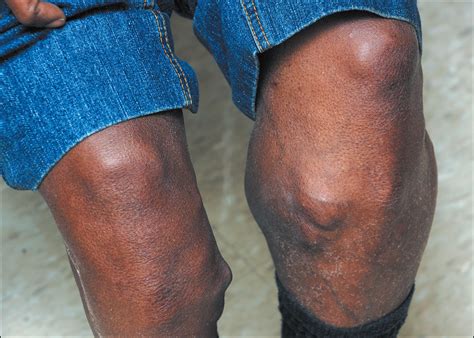 Types Of Foot Tumors at Julian Lentini blog