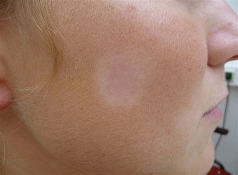 pityriasis alba causes - pictures, photos