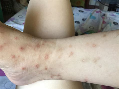 Do Bed Bug Bites Leave Permanent Scars at Gary Delong blog