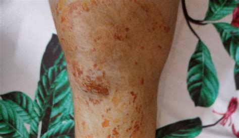 urgent support   ligament tear treatment ketto