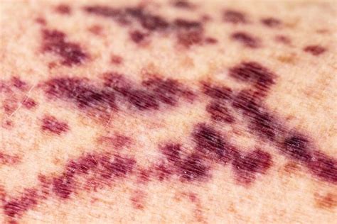 purpura types symptoms  diagnosis treatment