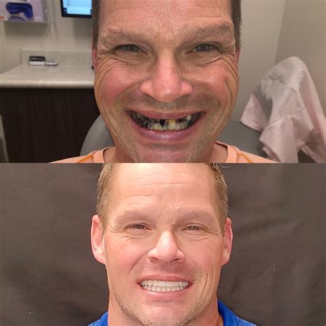 All on 4 Teeth in a Day — Memphis Dentures and Implants