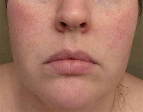 face rash rdermatologyquestions