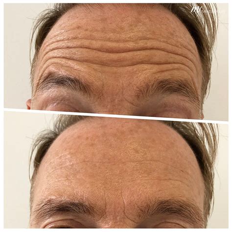 Wrinkle Treatment