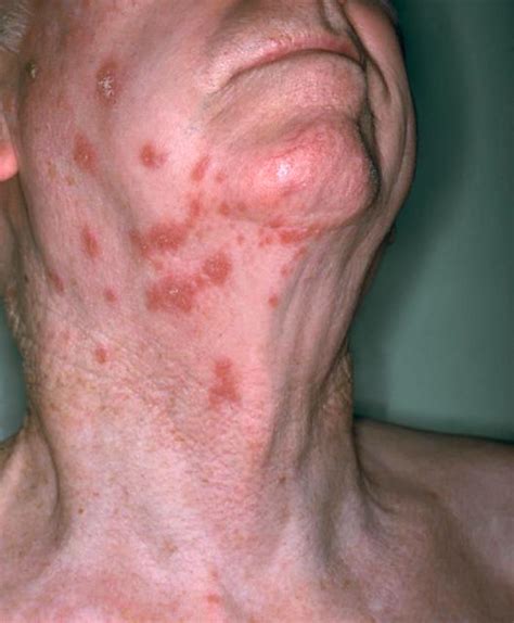 varicella zoster viruschickenpox concise medical knowledge