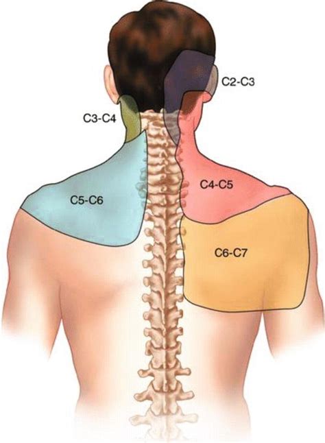 Understanding the Symptoms of a Herniated Disc in the Neck: C5-C6 Level ...