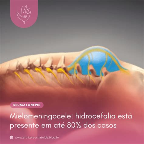 Meningocele E Hidrocefalia - Mielomeningocele: hidrocefalia está presente em até 80% dos casos ...