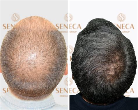 hair transplant  norwood scale  result  seneca