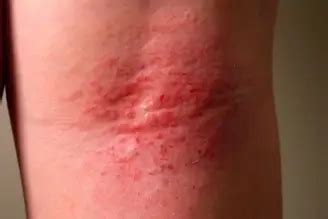 Flexural Eczema: Symptoms, Causes, and Treatments