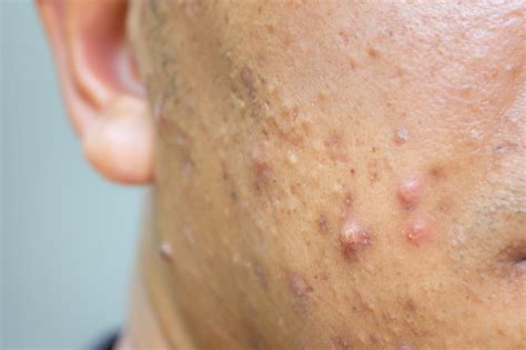 Cystic Acne: What Is It, Causes, Treatment and Home Remedies