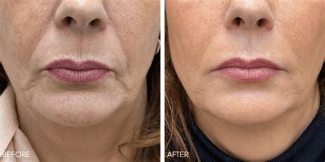 nasolabial fold filler london simply clinics