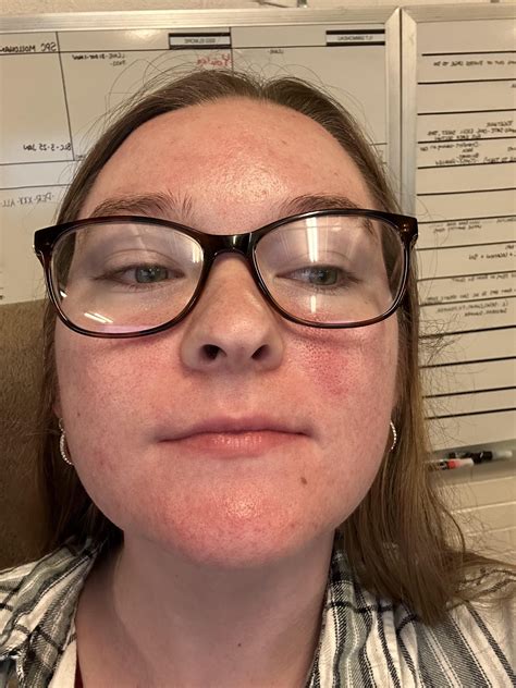 Baseline vs flare ups : r/Rosacea