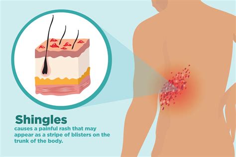 Shingles Symptoms