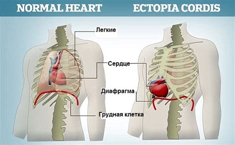 Эктопия сердца: что это такое, причины, симптомы, лечение и профилактика