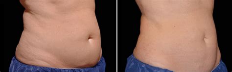 surgical fat reduction treatment  islamabad