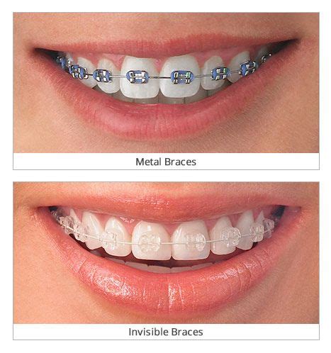 invisible braces  bushwick brooklyn clear invisalign aligners